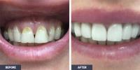 Full Mouth Dental Implants image 4